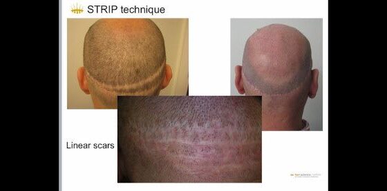 Le comuni tecniche di trapianto capelli: FUT (Strip) e F